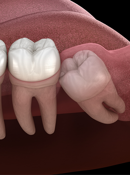 Illustration of impacted tooth