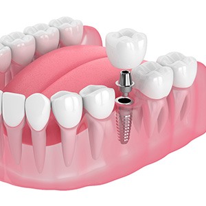 Illustration of a single dental implant