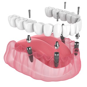 Illustration of an implant denture