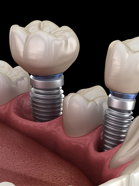Illustration of two dental implants in Frisco being placed
