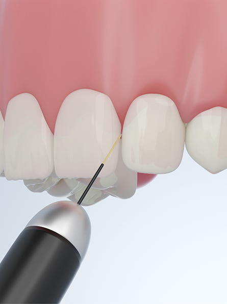 Treating patient's gums with soft tissue laser