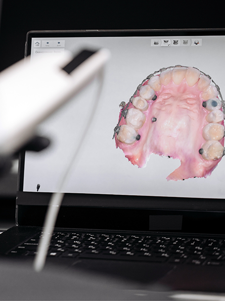 Cavity detection system with teeth displayed on monitor