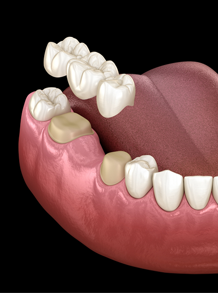 Illustration of dental bridge being placed in lower arch