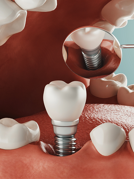 Illustration of dental implant and crown being placed