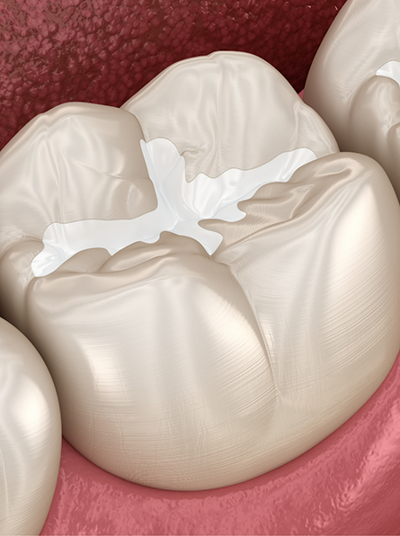 Illustration of teeth with tooth-colored fillings