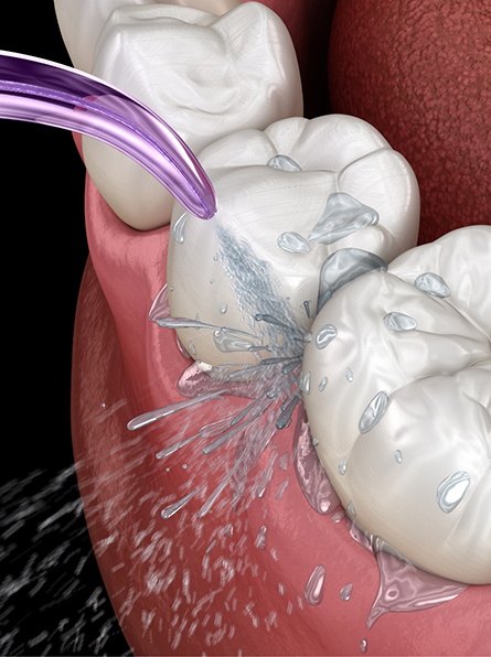 Illustration of teeth and gums being cleaned with pressurized water