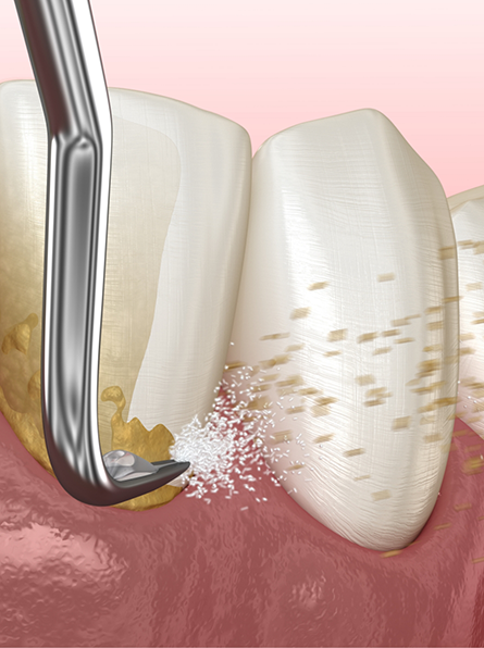 Illustration of scaling and root planing being performed