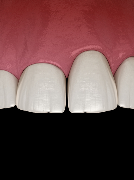 Illustration of gum recession making a tooth look unusually long