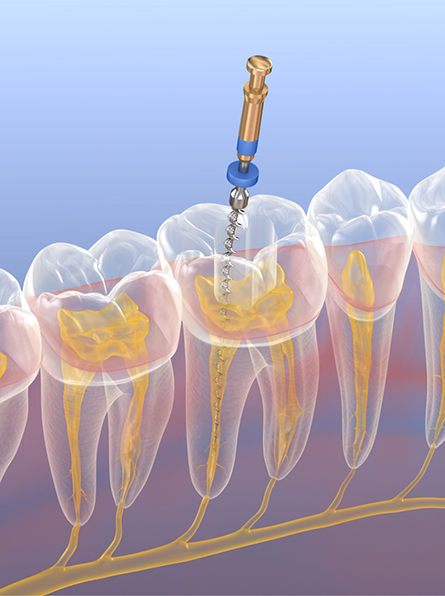 Illustration of root canal treatment in Frisco