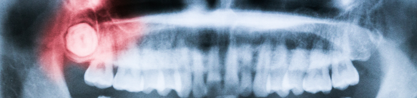 Dental X ray with wisdom tooth highlighted