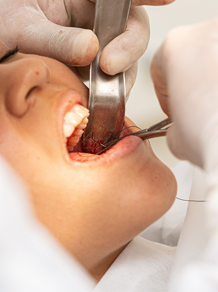 Patient holding mouth open for wisdom tooth extraction